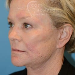 After Image: FACELIFT | FAT INJECTIONS | BROWLIFT | UPPER EYELID LIFT | PERIORAL DERMABRASION – 787 - left-front-oblique