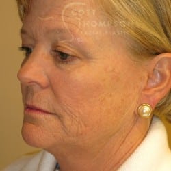 Before Image: FACELIFT | FAT INJECTIONS | BROWLIFT | UPPER EYELID LIFT | PERIORAL DERMABRASION – 787 - left-front-oblique