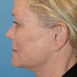 After Image: FACELIFT | FAT INJECTIONS | BROWLIFT | UPPER EYELID LIFT | PERIORAL DERMABRASION – 787 - left-side
