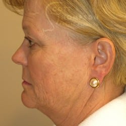 Before Image: FACELIFT | FAT INJECTIONS | BROWLIFT | UPPER EYELID LIFT | PERIORAL DERMABRASION – 787 - left-side