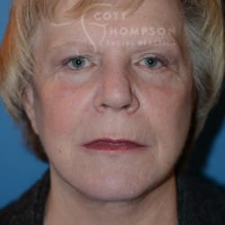 After Image: FACELIFT | FAT INJECTIONS | BROWLIFT | UPPER & LOWER EYELID SURGERY - front