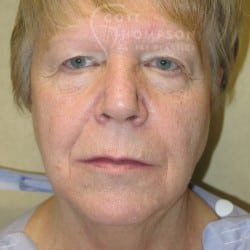 Before Image: FACELIFT | FAT INJECTIONS | BROWLIFT | UPPER & LOWER EYELID SURGERY - front