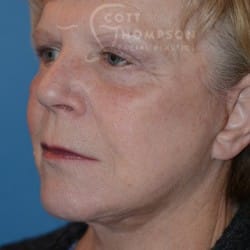 After Image: FACELIFT | FAT INJECTIONS | BROWLIFT | UPPER & LOWER EYELID SURGERY - left-front-oblique