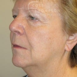 Before Image: FACELIFT | FAT INJECTIONS | BROWLIFT | UPPER & LOWER EYELID SURGERY - left-front-oblique