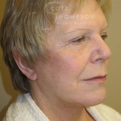 After Image: FACELIFT | FAT INJECTIONS | BROWLIFT | UPPER & LOWER EYELID SURGERY - right-front-oblique