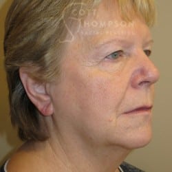 Before Image: FACELIFT | FAT INJECTIONS | BROWLIFT | UPPER & LOWER EYELID SURGERY - right-front-oblique
