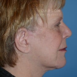 After Image: FACELIFT | FAT INJECTIONS | BROWLIFT | UPPER & LOWER EYELID SURGERY - right-side