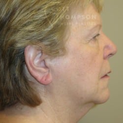 Before Image: FACELIFT | FAT INJECTIONS | BROWLIFT | UPPER & LOWER EYELID SURGERY - right-side