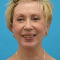 After Image: Facelift with Chin Implant by Dr Henstrom - front