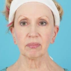 Before Image: Facelift with Chin Implant by Dr Henstrom - front