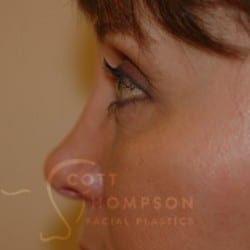 After Image: Lower Blepharoplasty by Dr. Thompson - left-side