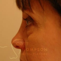 Before Image: Lower Blepharoplasty by Dr. Thompson - left-side