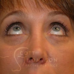 Lower Blepharoplasty Patient 126