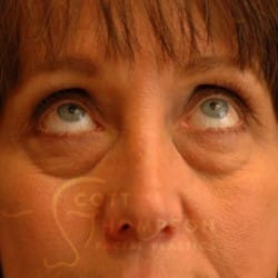 Before Image: Lower Blepharoplasty by Dr. Thompson - front
