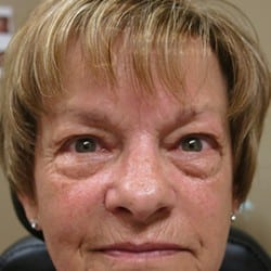 Before Image: Upper & Lower Blepharoplasty (Eyelid Lift) 815 - front