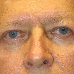 After Image: Upper & Lower Blepharoplasty by Dr. Thompson - front