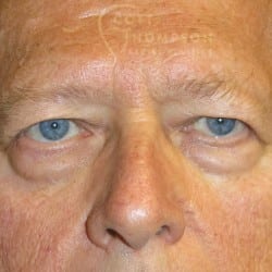 Before Image: Upper & Lower Blepharoplasty by Dr. Thompson - front
