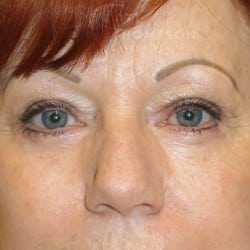After Image: Lower Blepharoplasty by Dr. Thompson - front