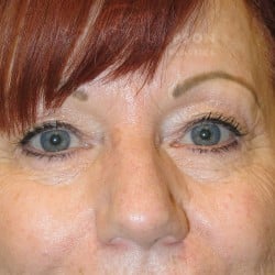 Before Image: Lower Blepharoplasty by Dr. Thompson - front