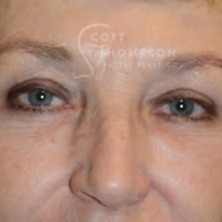 After Image: Upper Eyelid Surgery | Lower Eyelid Surgery with Fat Respositioning – 901 - front