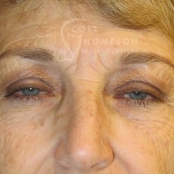 Before Image: Upper Eyelid Surgery | Lower Eyelid Surgery with Fat Respositioning – 901 - front