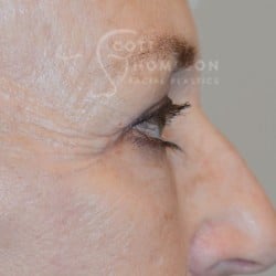 After Image: Upper Eyelid Surgery | Lower Eyelid Surgery with Fat Respositioning – 901 - right-side