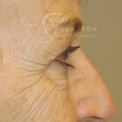 Before Image: Upper Eyelid Surgery | Lower Eyelid Surgery with Fat Respositioning – 901 - right-side