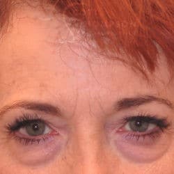 Before Image: Upper Eyelid Surgery | Lower Eyelid Surgery with Fat Repositioning – 699 - front