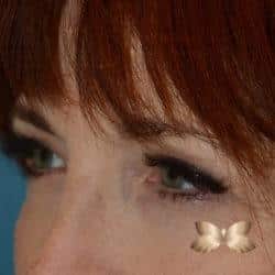 After Image: Upper Eyelid Surgery | Lower Eyelid Surgery with Fat Repositioning – 699 - left-front-oblique