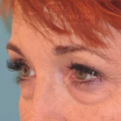 Before Image: Upper Eyelid Surgery | Lower Eyelid Surgery with Fat Repositioning – 699 - left-front-oblique