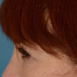 After Image: Upper Eyelid Surgery | Lower Eyelid Surgery with Fat Repositioning – 699 - left-side