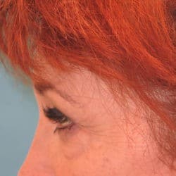 Before Image: Upper Eyelid Surgery | Lower Eyelid Surgery with Fat Repositioning – 699 - left-side
