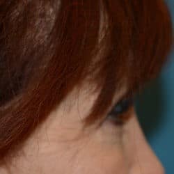 After Image: Upper Eyelid Surgery | Lower Eyelid Surgery with Fat Repositioning – 699 - right-side