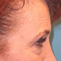 Before Image: Upper Eyelid Surgery | Lower Eyelid Surgery with Fat Repositioning – 699 - right-side