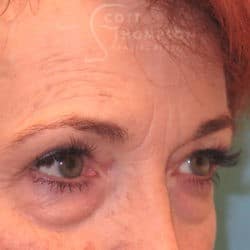Before Image: Upper Eyelid Surgery | Lower Eyelid Surgery with Fat Repositioning – 699 - right-front-oblique