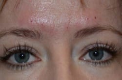 After Image: Upper and Lower Blepharoplasty with Fat Transfer by Dr. Thompson - front