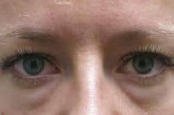Before Image: Upper and Lower Blepharoplasty with Fat Transfer by Dr. Thompson - front