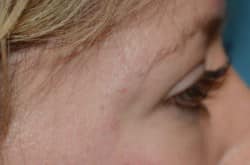 After Image: Upper and Lower Blepharoplasty with Fat Transfer by Dr. Thompson - right-side