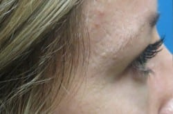 Before Image: Upper and Lower Blepharoplasty with Fat Transfer by Dr. Thompson - right-side