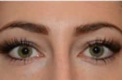 After Image: Lower Blepharoplasty with fat repositioning by Dr. Thompson - front