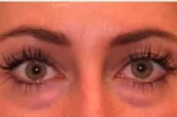 Before Image: Lower Blepharoplasty with fat repositioning by Dr. Thompson - front