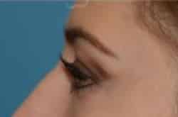 After Image: Lower Blepharoplasty with fat repositioning by Dr. Thompson - left-side