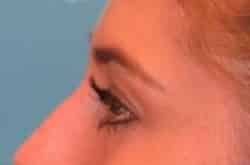 Before Image: Lower Blepharoplasty with fat repositioning by Dr. Thompson - left-side