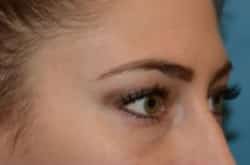 After Image: Lower Blepharoplasty with fat repositioning by Dr. Thompson - right-front-oblique