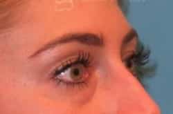 Before Image: Lower Blepharoplasty with fat repositioning by Dr. Thompson - right-front-oblique