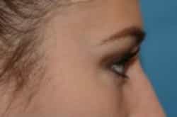 After Image: Lower Blepharoplasty with fat repositioning by Dr. Thompson - right-side