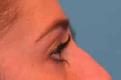 Before Image: Lower Blepharoplasty with fat repositioning by Dr. Thompson - right-side