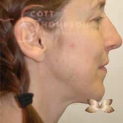 Rhinoplasty/Chin Augmentation Patient 09