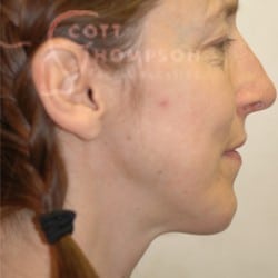 Rhinoplasty/Chin Augmentation Patient 09