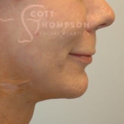 After Image: Facelift and Chin Implant by Dr. Thompson